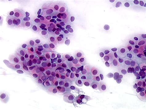 atrophic pattern pap smear|The Pap (Papanicolaou) Test .